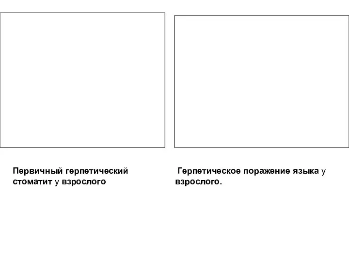 Герпетическое поражение языка у взрослого. Первичный герпетический стоматит у взрослого