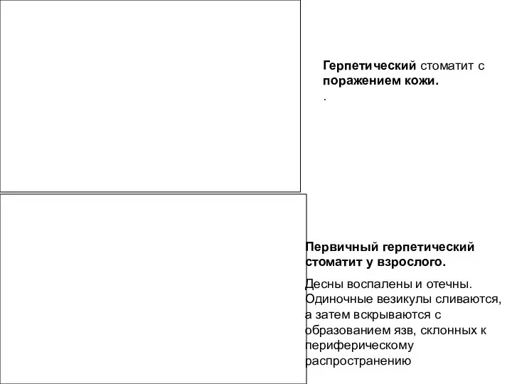 Герпетический стоматит с поражением кожи. . Первичный герпетический стоматит у взрослого.