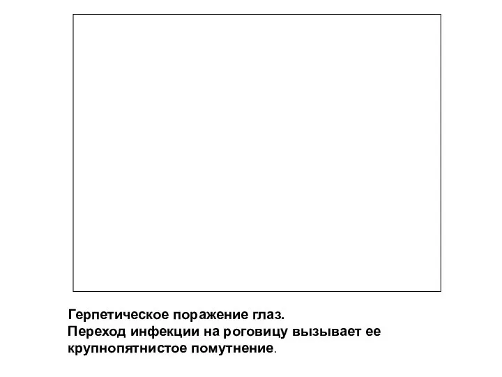 Герпетическое поражение глаз. Переход инфекции на роговицу вызывает ее крупнопятнистое помутнение.