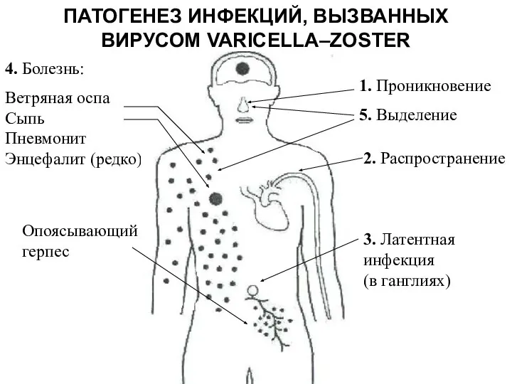 ПАТОГЕНЕЗ ИНФЕКЦИЙ, ВЫЗВАННЫХ ВИРУСОМ VARICELLA–ZOSTER 4. Болезнь: Ветряная оспа Сыпь Пневмонит