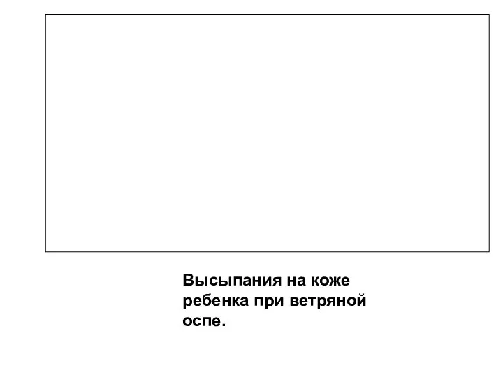 Высыпания на коже ребенка при ветряной оспе.