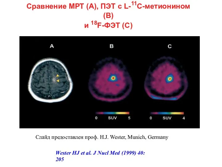 Сравнение МРТ (А), ПЭТ с L-11C-метионином (В) и 18F-ФЭТ (С) Слайд