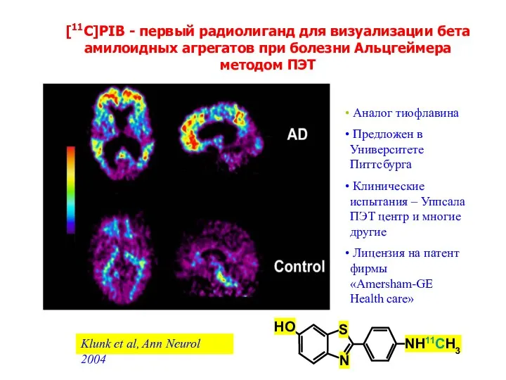 [11C]PIB - первый радиолиганд для визуализации бета амилоидных aгрегaтoв при болезни
