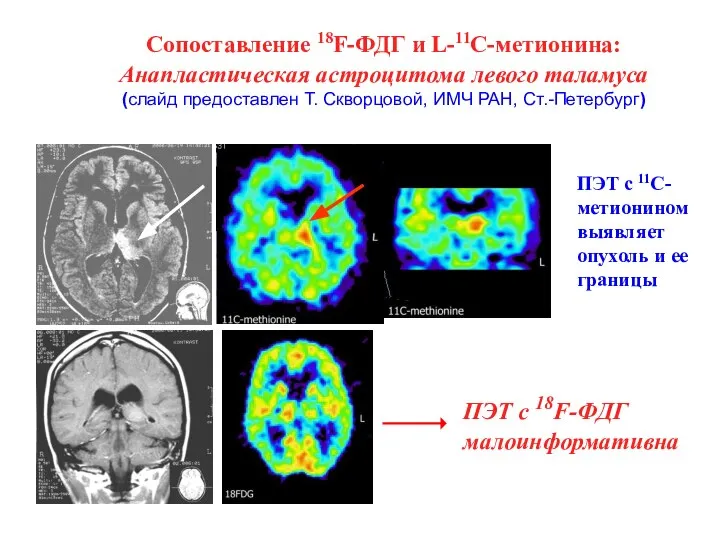 ПЭТ с 11С-метионином выявляет опухоль и ее границы Сопоставление 18F-ФДГ и