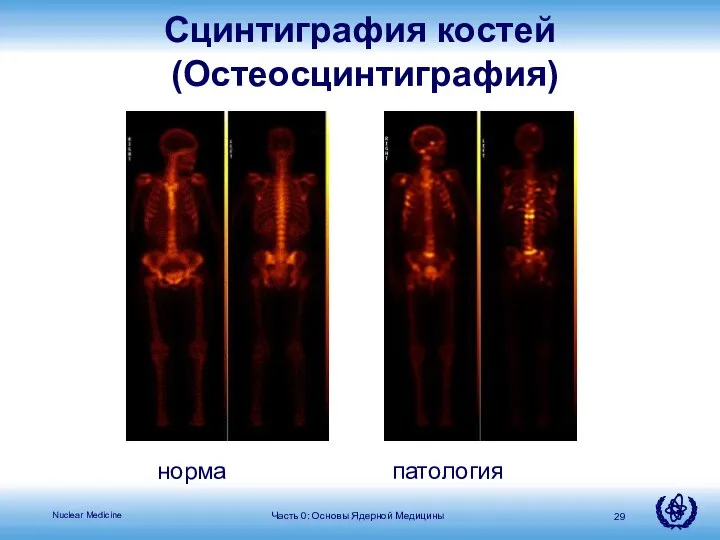 норма патология Сцинтиграфия костей (Остеосцинтиграфия) Часть 0: Основы Ядерной Медицины