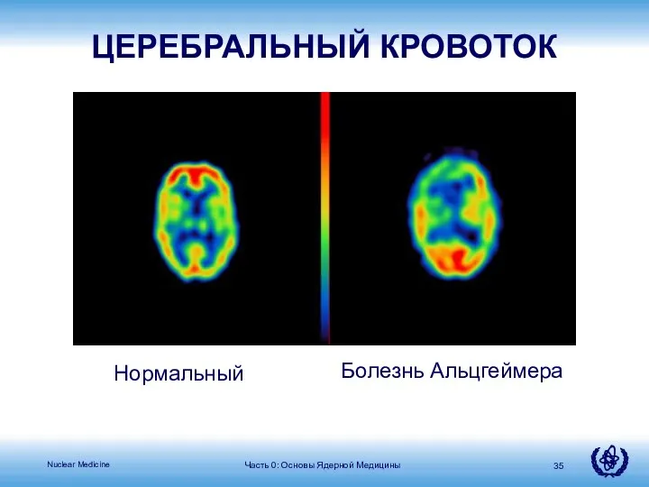 Часть 0: Основы Ядерной Медицины Нормальный Болезнь Альцгеймера ЦЕРЕБРАЛЬНЫЙ КРОВОТОК