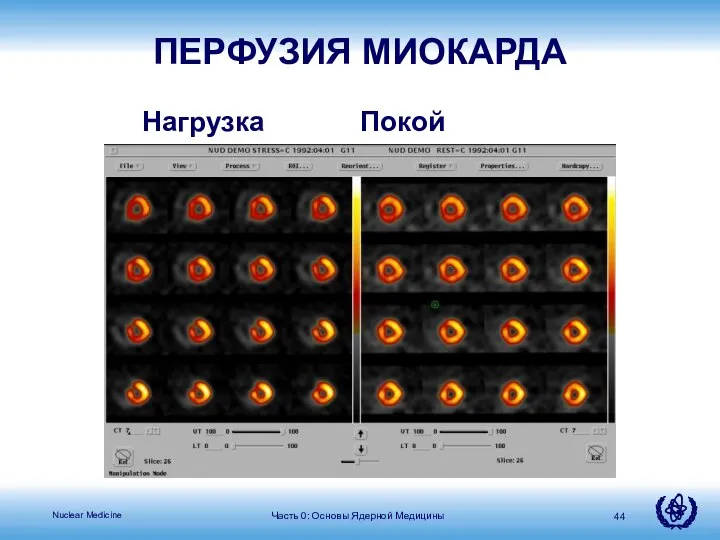 Часть 0: Основы Ядерной Медицины Нагрузка Покой ПЕРФУЗИЯ МИОКАРДА