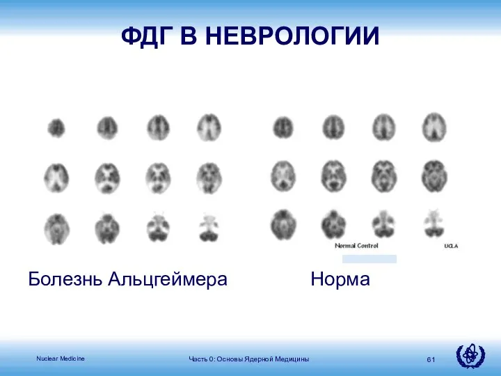 Часть 0: Основы Ядерной Медицины Болезнь Альцгеймера Норма ФДГ В НЕВРОЛОГИИ