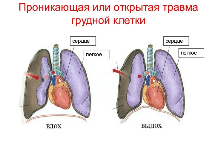 Проникающая или открытая травма грудной клетки сердце легкое легкое сердце