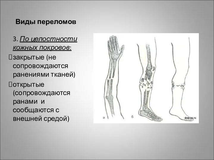 Виды переломов 3. По целостности кожных покровов: закрытые (не сопровождаются ранениями