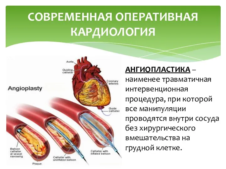 СОВРЕМЕННАЯ ОПЕРАТИВНАЯ КАРДИОЛОГИЯ АНГИОПЛАСТИКА – наименее травматичная интервенционная процедура, при которой