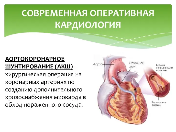 СОВРЕМЕННАЯ ОПЕРАТИВНАЯ КАРДИОЛОГИЯ АОРТОКОРОНАРНОЕ ШУНТИРОВАНИЕ (АКШ) – хирургическая операция на коронарных