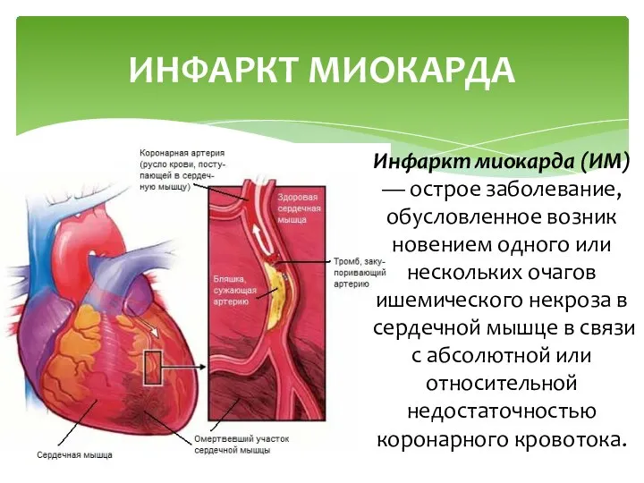 Инфаркт миокарда (ИМ) — острое заболевание, обусловленное возник­новением одного или нескольких