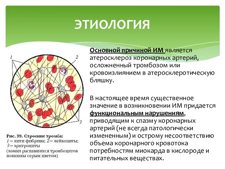 Основной причиной ИМ является атеросклероз коронарных артерий, осложненный тромбозом или кровоизлиянием