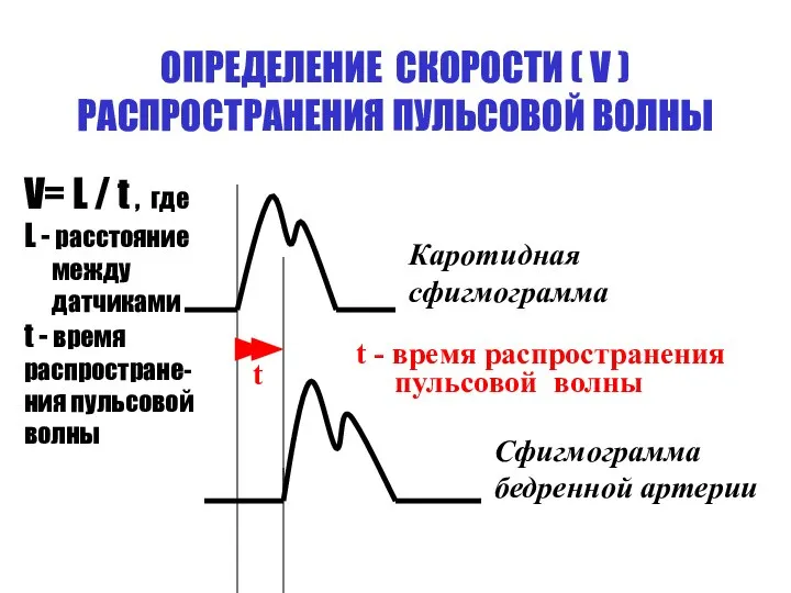 ОПРЕДЕЛЕНИЕ СКОРОСТИ ( V ) РАСПРОСТРАНЕНИЯ ПУЛЬСОВОЙ ВОЛНЫ t Каротидная сфигмограмма