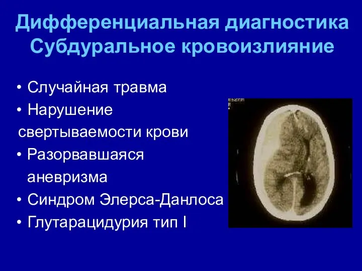 Дифференциальная диагностика Субдуральное кровоизлияние Случайная травма Нарушение свертываемости крови Разорвавшаяся аневризма Синдром Элерса-Данлоса Глутарацидурия тип I