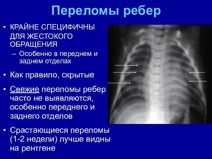 Переломы ребер КРАЙНЕ СПЕЦИФИЧНЫ ДЛЯ ЖЕСТОКОГО ОБРАЩЕНИЯ Особенно в переднем и