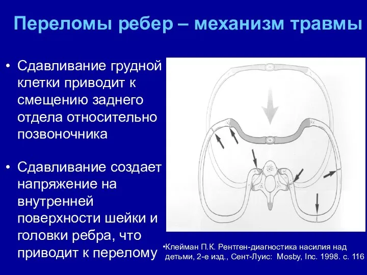 Переломы ребер – механизм травмы Сдавливание грудной клетки приводит к смещению