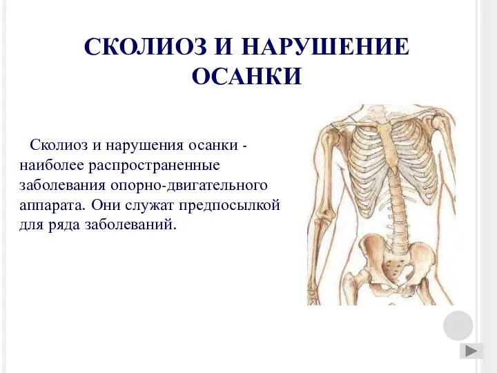 СКОЛИОЗ И НАРУШЕНИЕ ОСАНКИ Сколиоз и нарушения осанки - наиболее распространенные