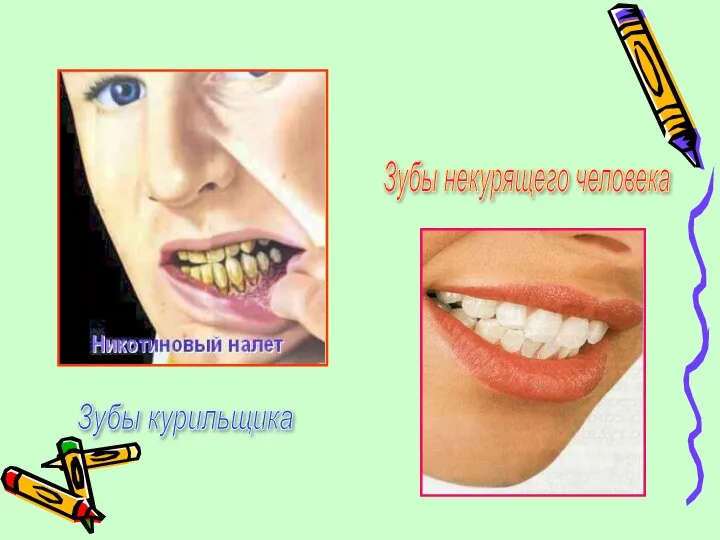 Зубы курильщика Зубы некурящего человека