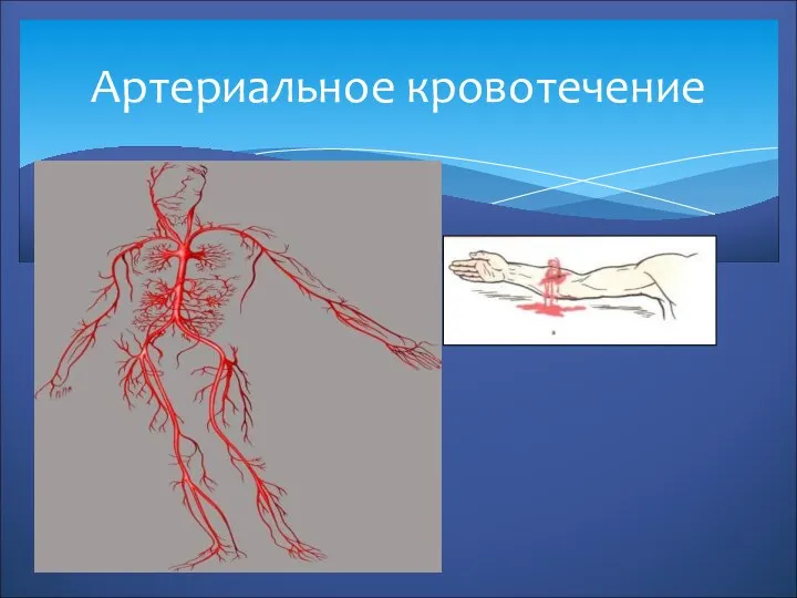 Артериальное кровотечение