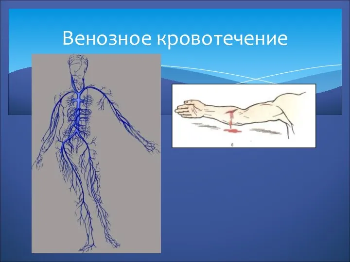 Венозное кровотечение