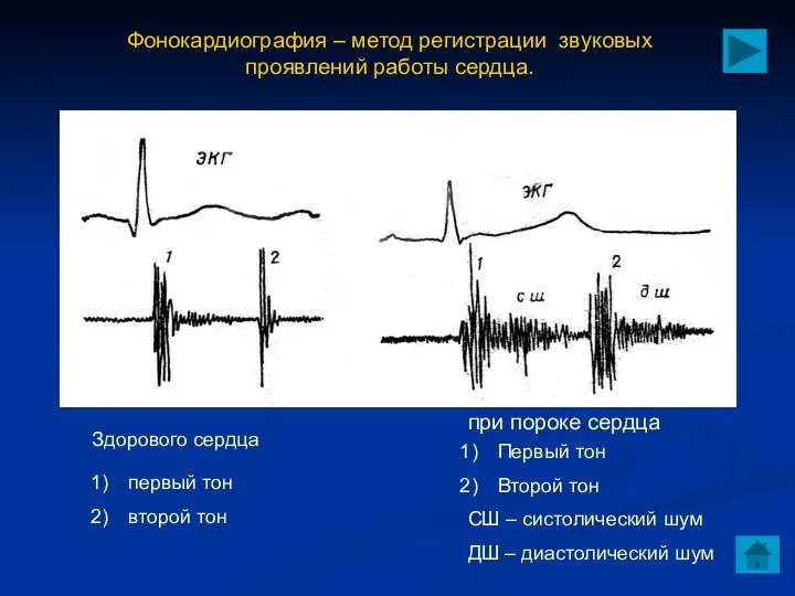 Здорового сердца при пороке сердца Фонокардиография – метод регистрации звуковых проявлений