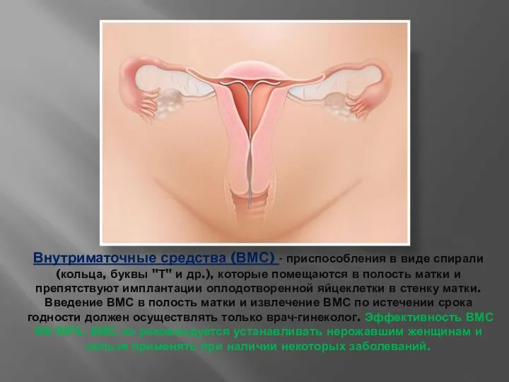 Внутриматочные средства (ВМС) - приспособления в виде спирали (кольца, буквы "Т"