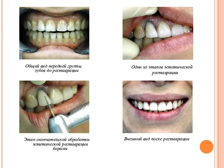 Общий вид передней группы зубов до реставрации Один из этапов эстетической
