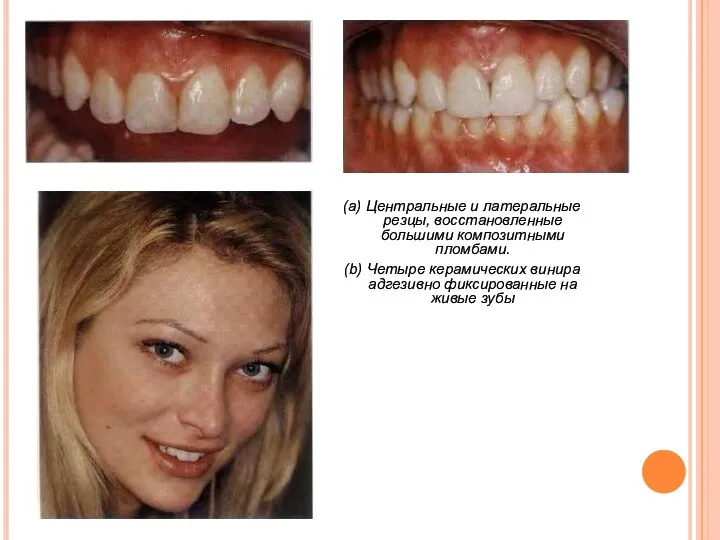 (а) Центральные и латеральные резцы, восстановленные большими композитными пломбами. (b) Четыре