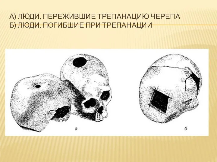 А) Люди, пережившие трепанацию черепа Б) Люди, погибшие при трепанации