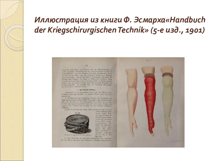 Иллюстрация из книги Ф. Эсмарха«Handbuch der Kriegschirurgischen Technik» (5-е изд., 1901)