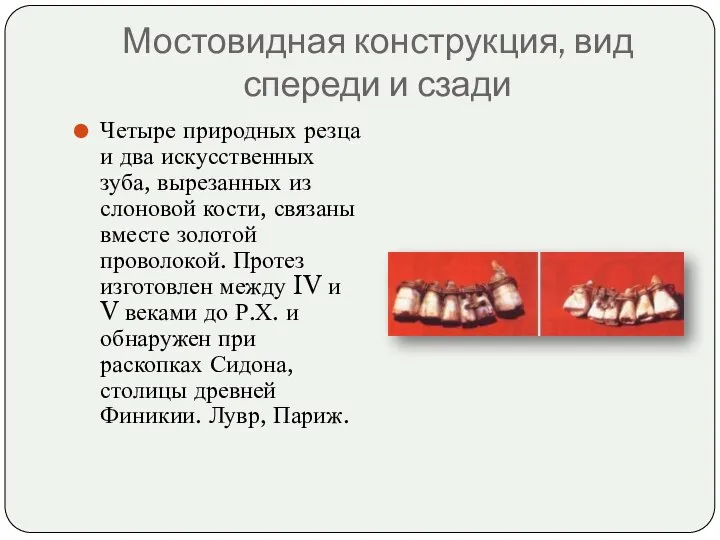 Мостовидная конструкция, вид спереди и сзади Четыре природных резца и два