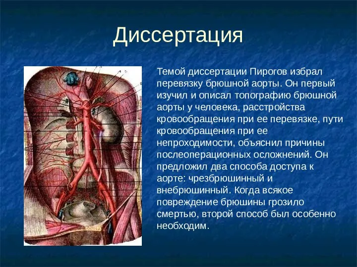 Диссертация Темой диссертации Пирогов избрал перевязку брюшной аорты. Он первый изучил