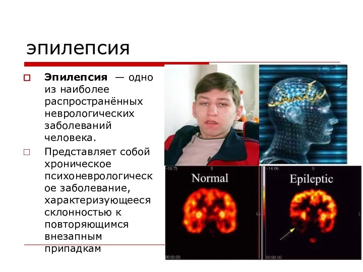 эпилепсия Эпилепсия — одно из наиболее распространённых неврологических заболеваний человека. Представляет