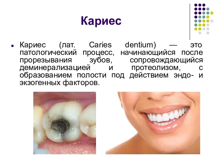 Кариес Кариес (лат. Caries dentium) — это патологический процесс, начинающийся после