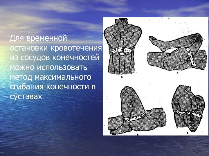 Для временной остановки кровотечения из сосудов конечностей можно использовать метод максимального сгибания конечности в суставах