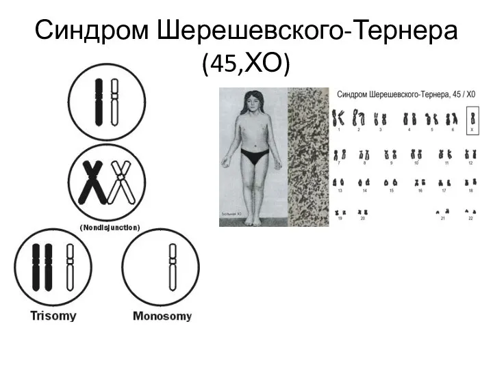 Синдром Шерешевского-Тернера (45,ХО)