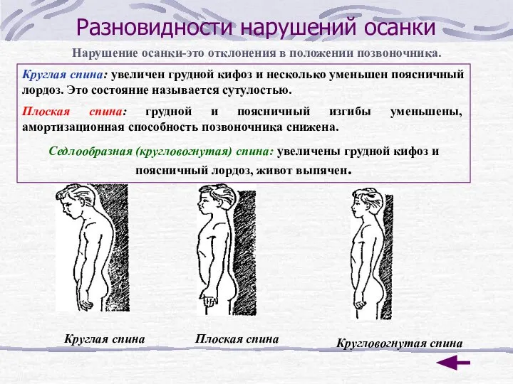 Разновидности нарушений осанки Нарушение осанки-это отклонения в положении позвоночника. Круглая спина: