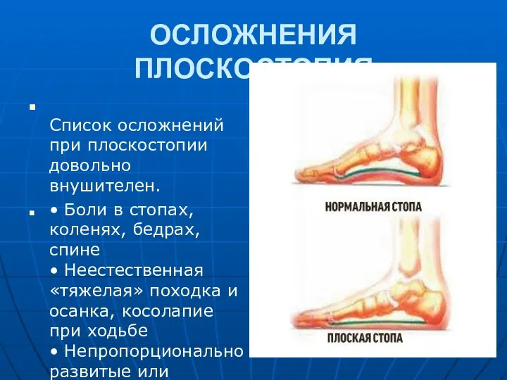 ОСЛОЖНЕНИЯ ПЛОСКОСТОПИЯ Список осложнений при плоскостопии довольно внушителен. • Боли в