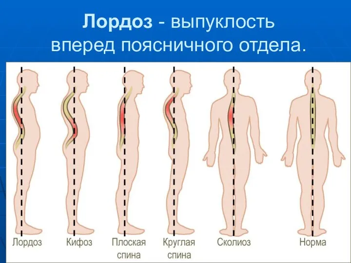 Лордоз - выпуклость вперед поясничного отдела.