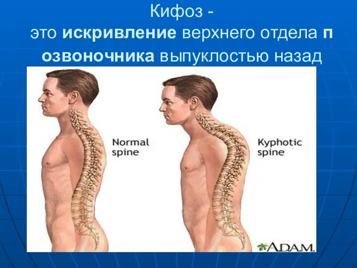 Кифоз - это искривление верхнего отдела позвоночника выпуклостью назад