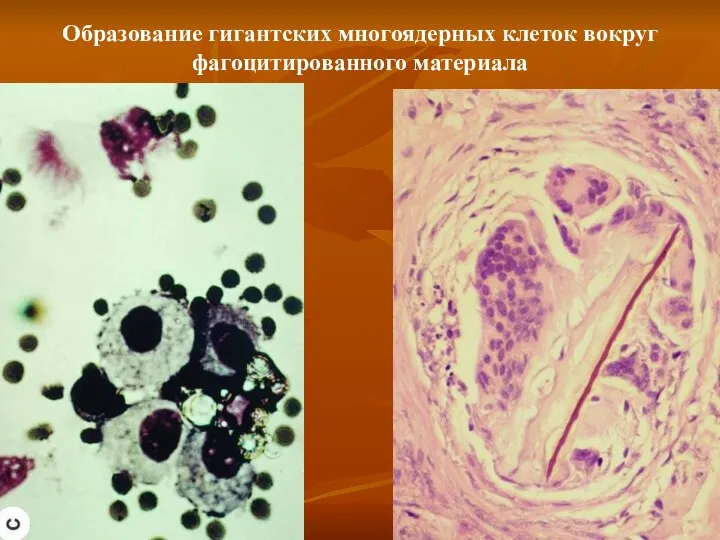 Образование гигантских многоядерных клеток вокруг фагоцитированного материала