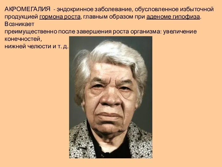 АКРОМЕГАЛИЯ - эндокринное заболевание, обусловленное избыточной продукцией гормона роста, главным образом