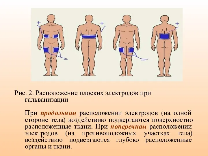 Рис. 2. Расположение плоских электродов при гальванизации При продольном расположении электродов