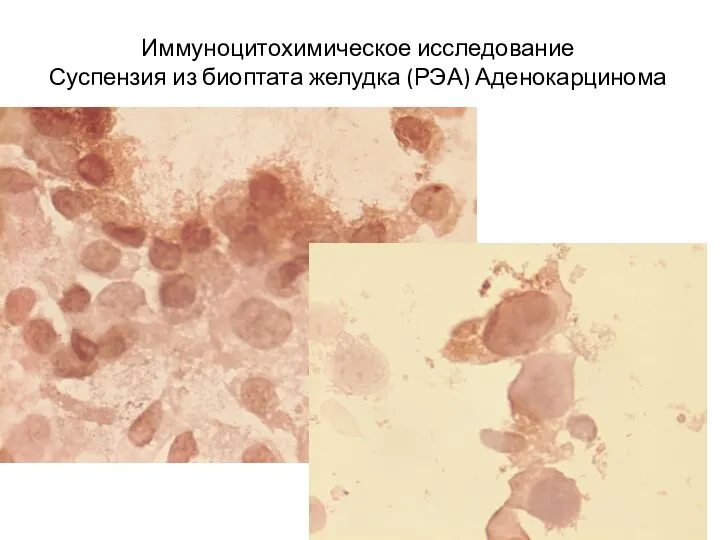 Иммуноцитохимическое исследование Суспензия из биоптата желудка (РЭА) Аденокарцинома