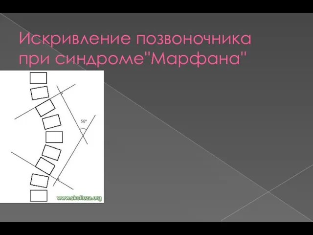 Искривление позвоночника при синдроме''Марфана''