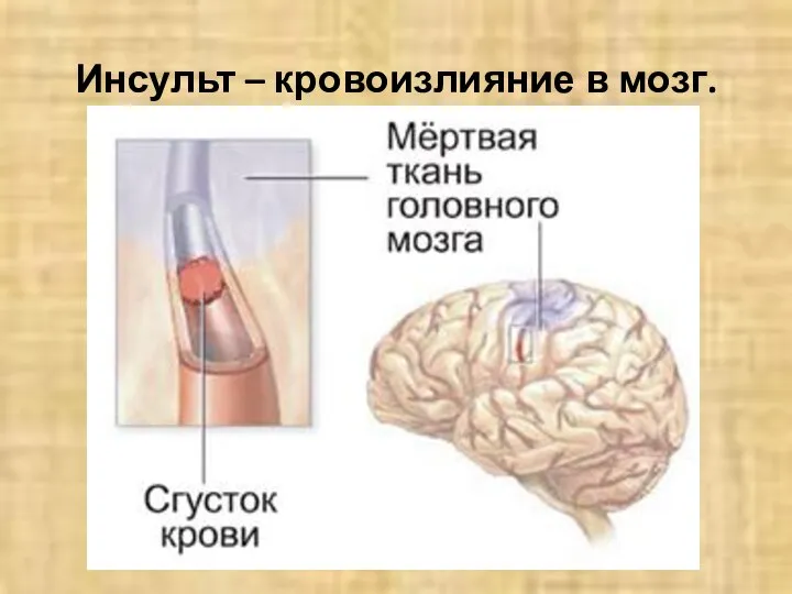 Инсульт – кровоизлияние в мозг.