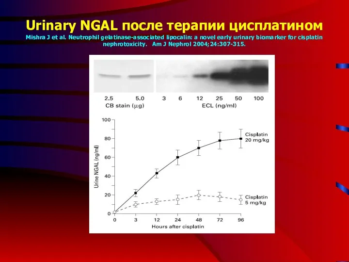 Urinary NGAL после терапии цисплатином Mishra J et al. Neutrophil gelatinase-associated