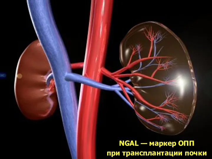 NGAL — маркер ОПП при трансплантации почки
